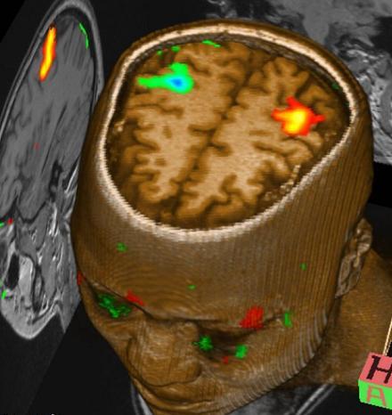  fMri   